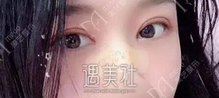 陈锦安双眼皮案例分享|眯眯眼就此离我而去!