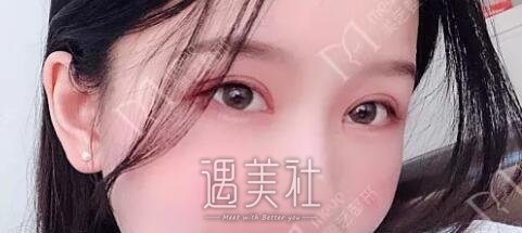 陈锦安双眼皮案例分享|眯眯眼就此离我而去!
