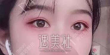 陈锦安双眼皮案例分享|眯眯眼就此离我而去!