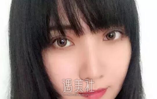 金云波双眼皮真实案例分享，看看她的变美历程!