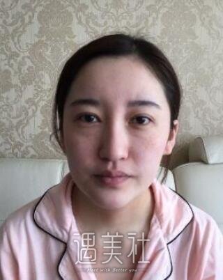 九院曹谊林隆鼻全过程展示~塌鼻子轻松甩掉!