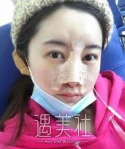 九院曹谊林隆鼻全过程展示~塌鼻子轻松甩掉!