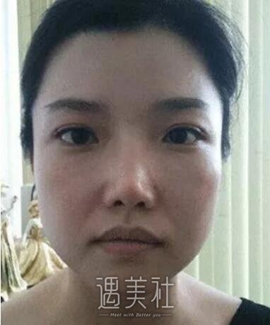 九院曹谊林下颌角磨骨案例展示：脸型是如此重要!