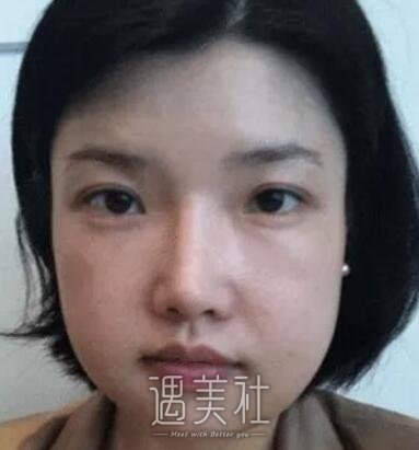 九院曹谊林下颌角磨骨案例展示：脸型是如此重要!