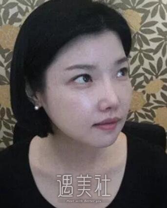 九院曹谊林下颌角磨骨案例展示：脸型是如此重要!