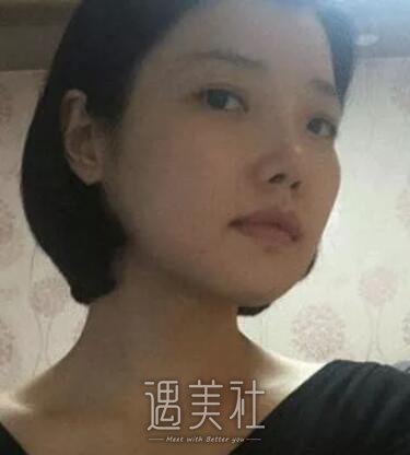 九院曹谊林下颌角磨骨案例展示：脸型是如此重要!