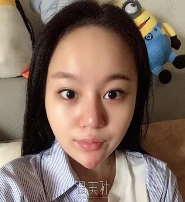 九院王炜隆鼻真实案例分享~前后变化确实很大!