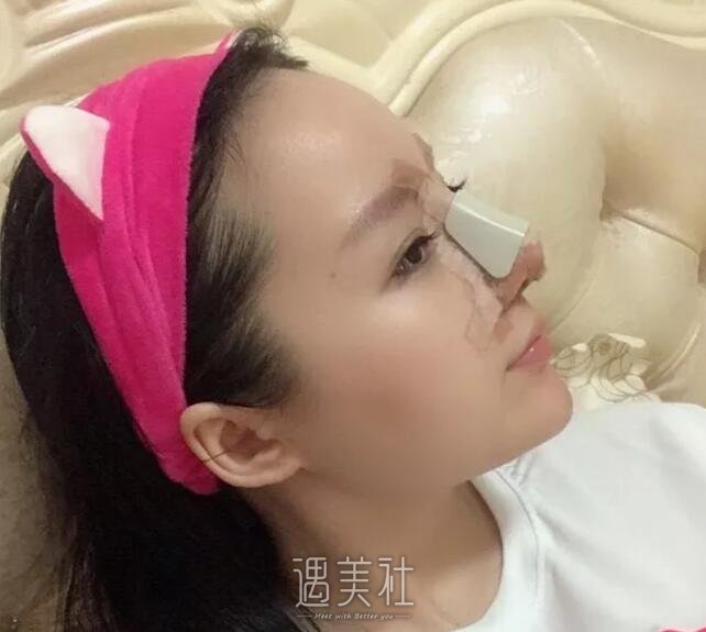 九院王炜隆鼻真实案例分享~前后变化确实很大!