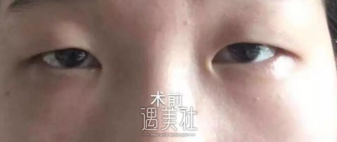 九院敏双眼皮案例展示~鬼斧神工般的操作让我惊叹!