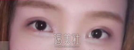 九院敏双眼皮案例展示~鬼斧神工般的操作让我惊叹!