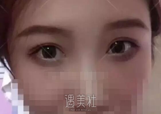九院敏双眼皮案例展示~鬼斧神工般的操作让我惊叹!