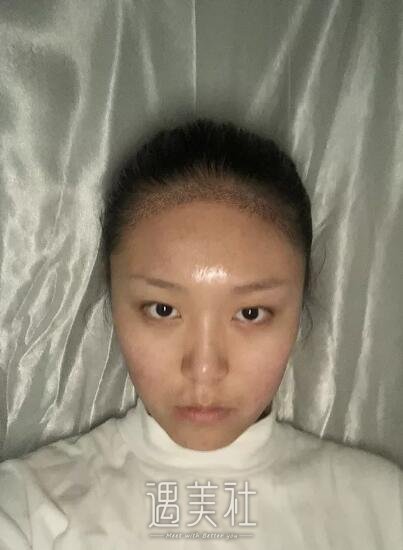 九院吴巍植发案例分享~我也能草地变森林!