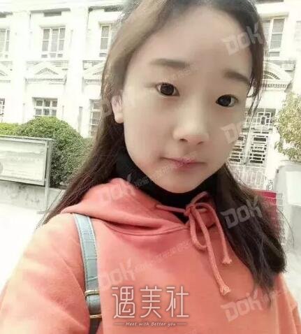 九院杨军双眼皮案例展示，看看我的这个双眼皮从何而来!