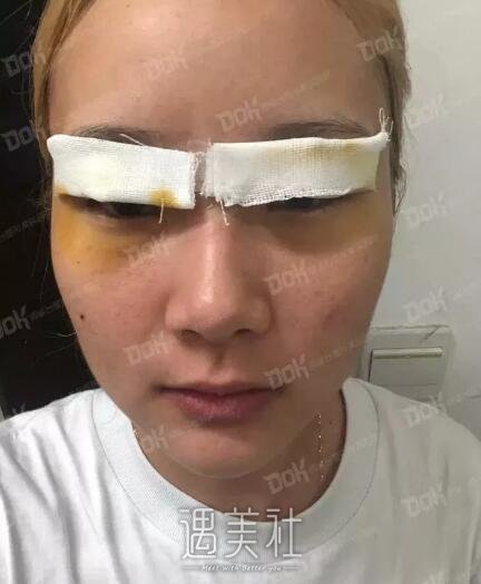 九院杨军双眼皮案例展示，看看我的这个双眼皮从何而来!