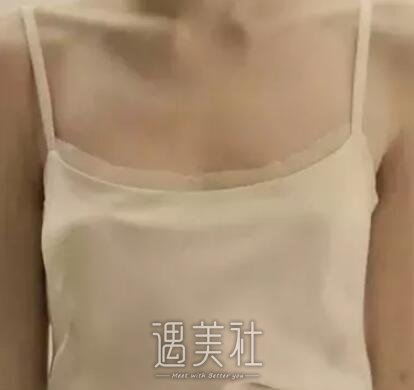 九院余力隆胸案例分享~看看我是如何拥有傲人胸脯的!
