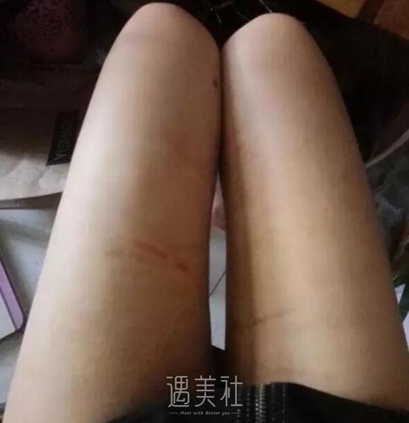 九院余力吸脂案例展示，看看他的技术是否真的这么强!