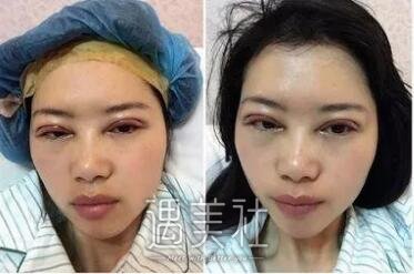 九院张路双眼皮案例展示，看看拥有双眼皮前后的差距~