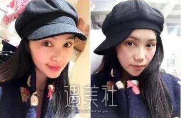 九院张路双眼皮案例展示，看看拥有双眼皮前后的差距~