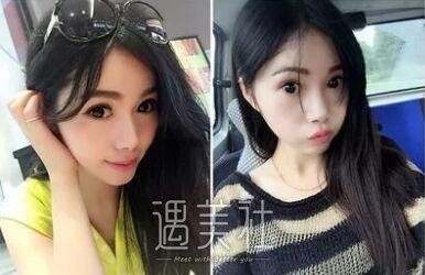 九院张路双眼皮案例展示，看看拥有双眼皮前后的差距~