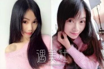 九院张路双眼皮案例展示，看看拥有双眼皮前后的差距~