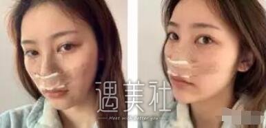 祝联隆鼻案例分享，短鼻也是可以改变的!