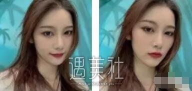 祝联隆鼻案例分享，短鼻也是可以改变的!
