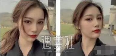 祝联隆鼻案例分享，短鼻也是可以改变的!