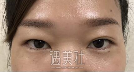 祝联双眼皮真实案例分享，看看小眼睛是如何逆袭的!