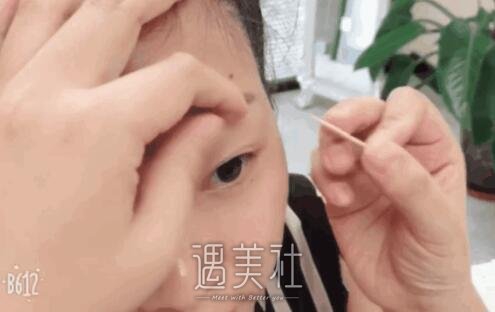 祝联双眼皮真实案例分享，看看小眼睛是如何逆袭的!