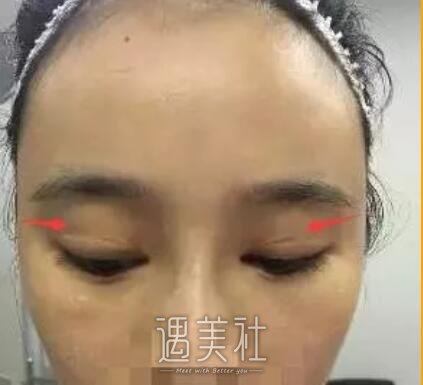 祝联双眼皮修复案例展示，回归过去不是梦!