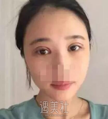 祝联双眼皮修复案例展示，回归过去不是梦!