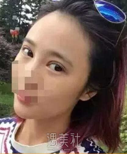 祝联双眼皮修复案例展示，回归过去不是梦!