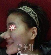 首尔丽格崔荣达迷你双鄂整形手术案例：颜值提升仨等级 width=