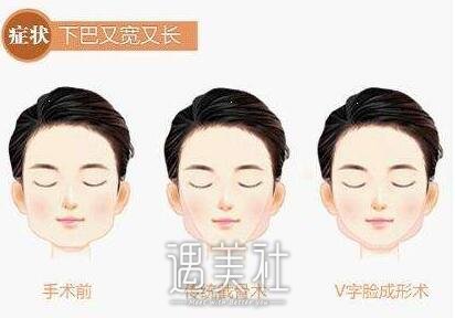 下颌角整形专家