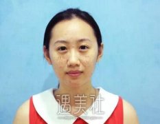 c8激光祛斑果怎么样|c8激光祛斑真实案例告诉你~ width=