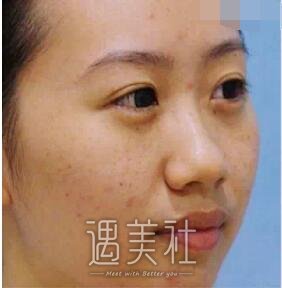 c8激光祛斑