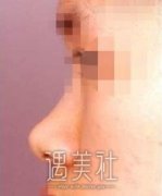 耳软骨隆鼻尖果照片分享——来自耳软骨隆鼻尖案例~ width=