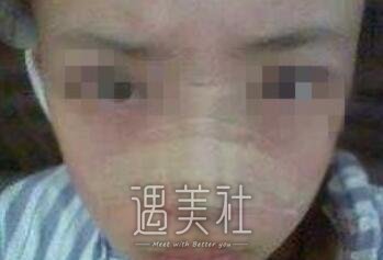 耳软骨隆鼻尖