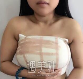 武汉,同济,吴毅平,缩胸