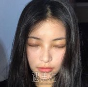 北京301医院医生名单公开｜内含韩岩全切双眼皮案例 width=
