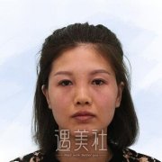 金云波中面部提升案例：术后紧绷有弹性 width=