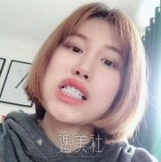 九院张富强牙齿矫正案例：半年后妥妥小仙女 width=