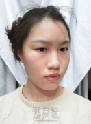 张敬德双眼皮案列：恢复了这么久也没有留疤 width=