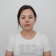 张瑞红双眼皮案例：明眸大眼远离双眼皮贴 width=