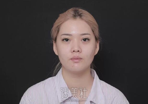 胶原蛋白隆鼻果好吗?刚做两个月的我有资格来说说～