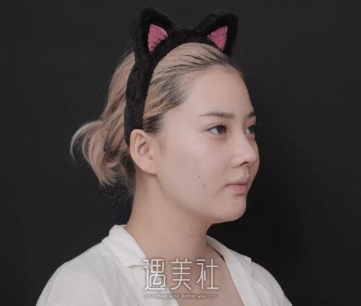 胶原蛋白隆鼻果好吗?刚做两个月的我有资格来说说～