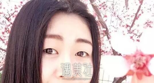 上海蔡仁祥双眼皮做得怎么样|蔡仁祥割双眼皮案例硬核力证～