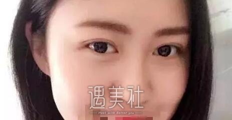 上海蔡仁祥双眼皮做得怎么样|蔡仁祥割双眼皮案例硬核力证～