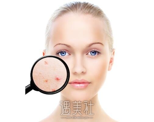 像素激光果到底怎么样?周末想去做像素激光祛痘~