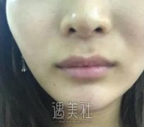 玻尿酸丰唇果到底好不好？上周刚做的我有些话想说～ width=